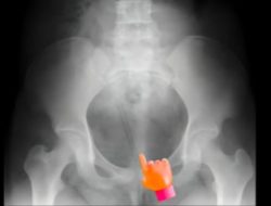 Dokter Temukan Pencil di Kandung Kemih Anak 12 Tahun, Waspadai Lingkungan Anak