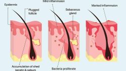 Cara Mengatasi Purging Retinol Tanpa Khawatir