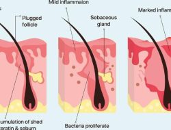 Cara Mengatasi Purging Retinol Tanpa Khawatir